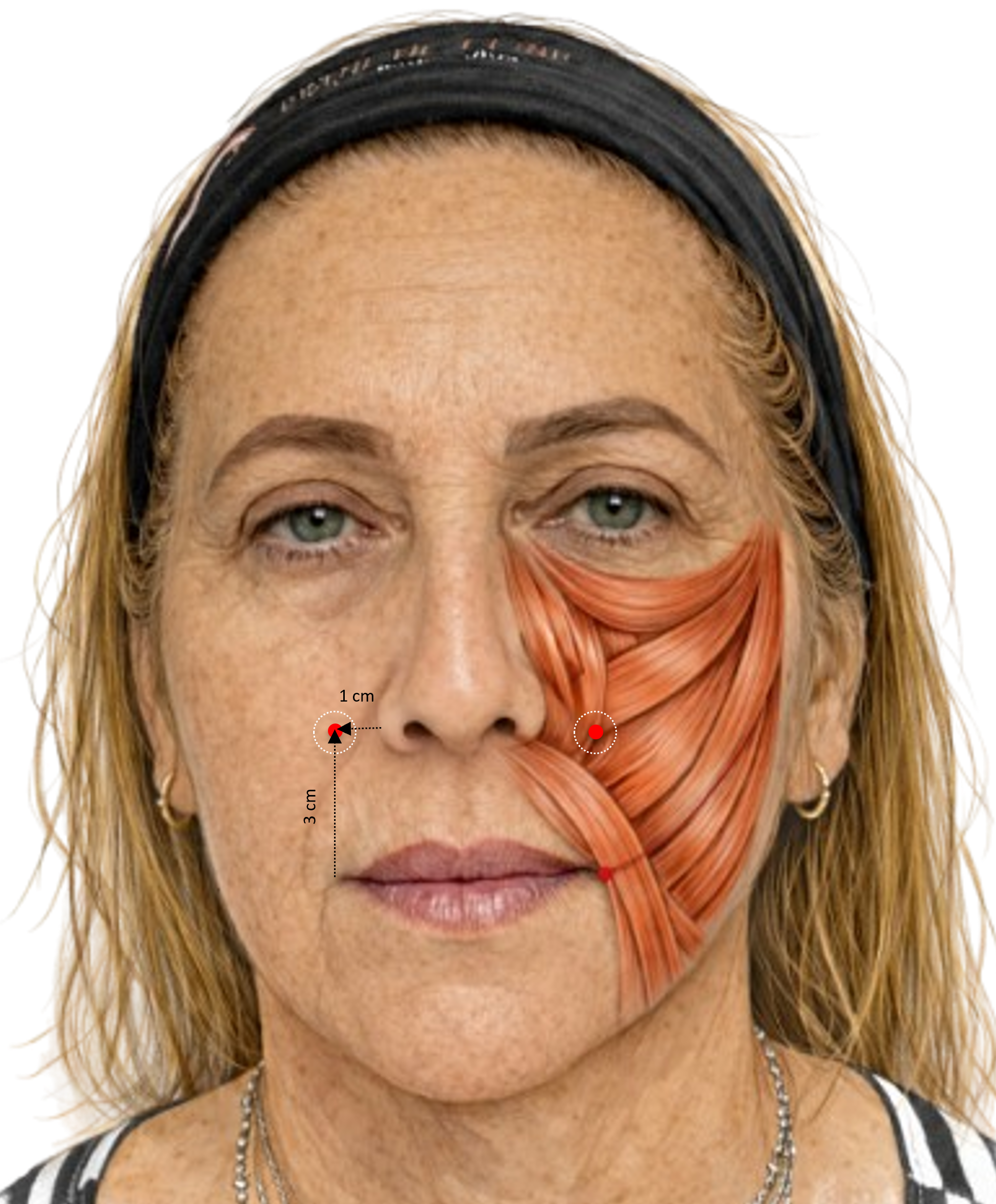 Clinical-anatomical topography of the Yonsei point