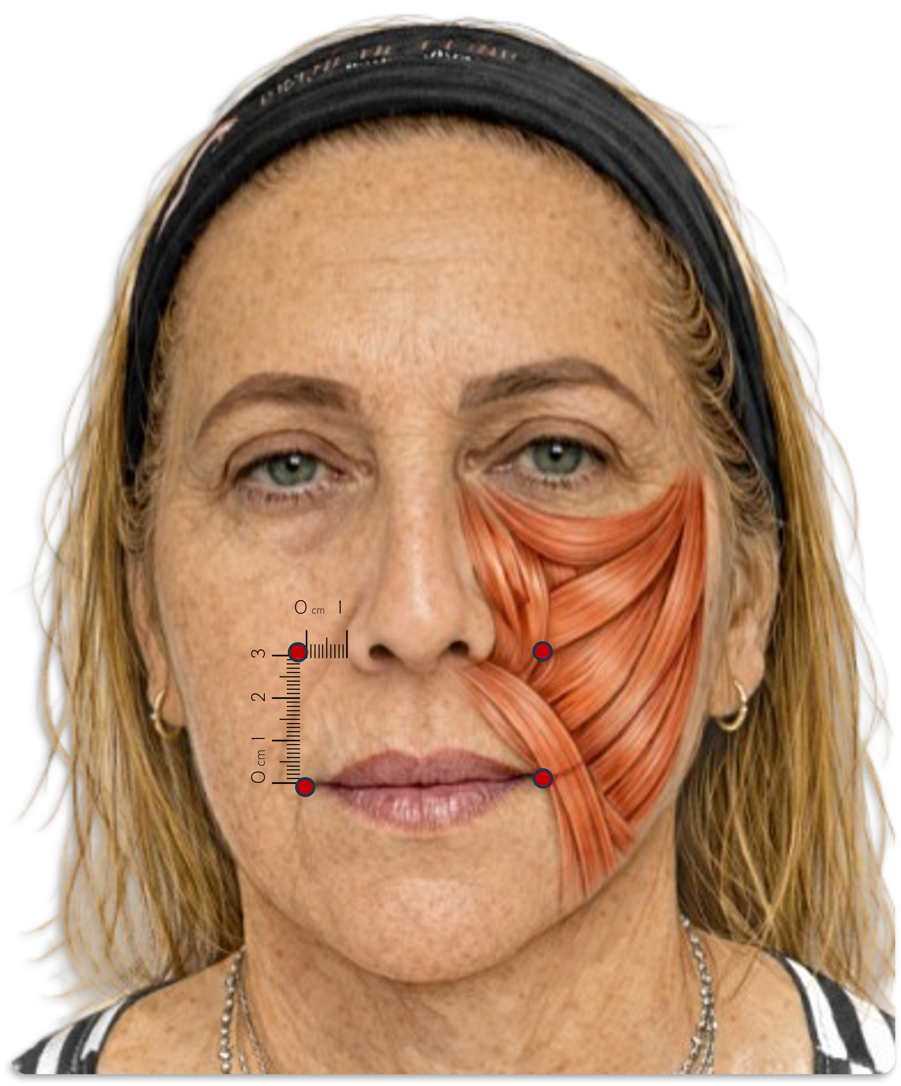 Clinical-anatomical topography of the Yonsei point
