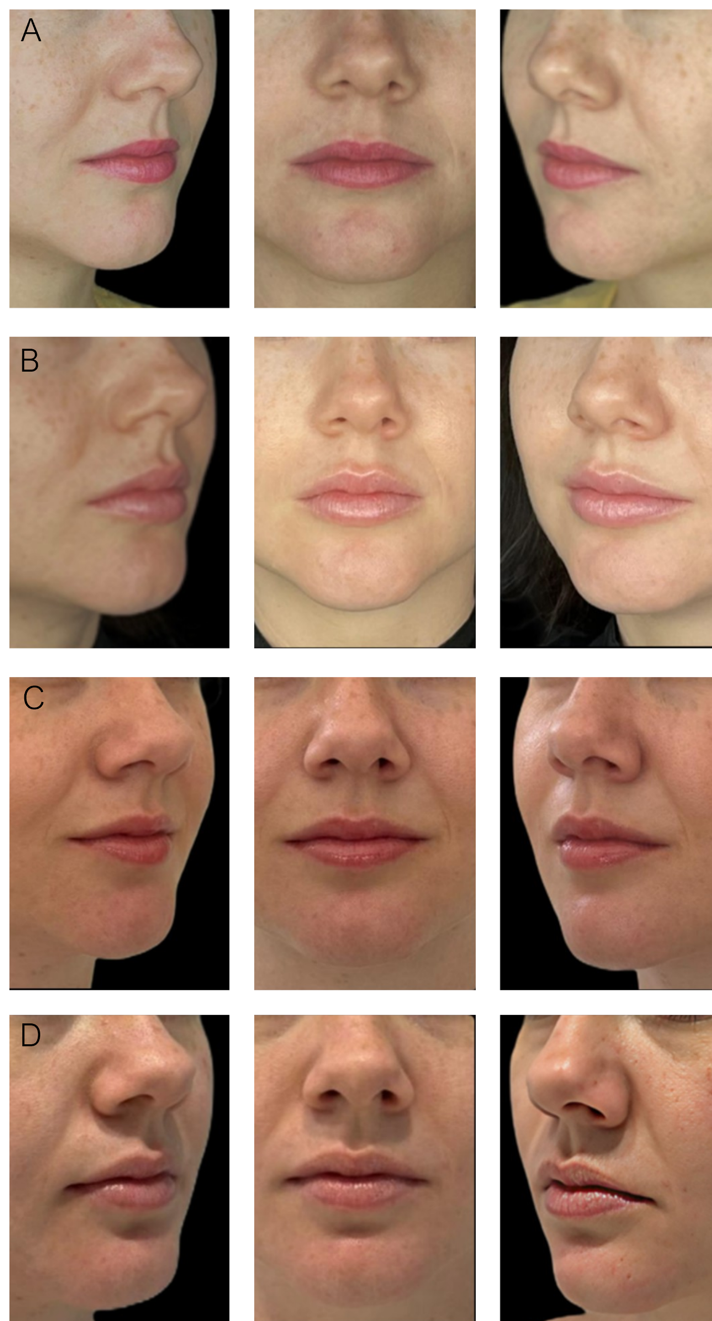 Figure 1. Serial standardized photographs after conservative lip augmentation.